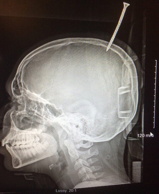 Radiografía de la cabeza del joven Imagen: Alan Cohen/Johns Hopkins Medicine